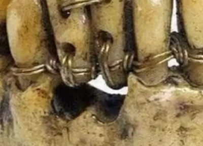 ارتودنسی دندان ها در مصر باستان