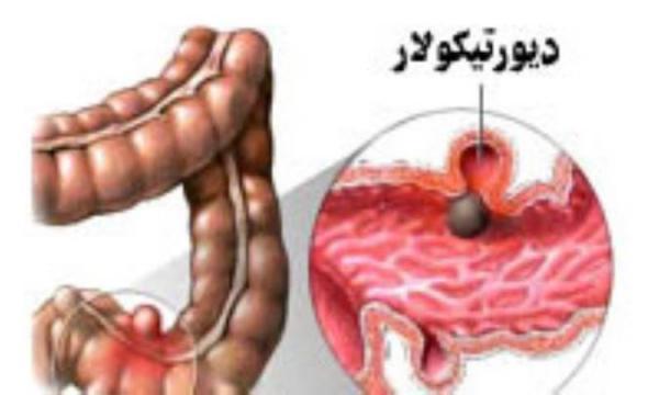 درمان بیماری دیورتیکولار با تغذیه مناسب